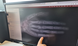 Eski̇şehi̇r'de Kanser Alarmı! Her Ay 5-7 Çocuğa Tanı Konuluyor