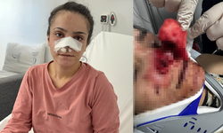 Eşinin Burnunu Isırarak Koparan Cani Adam Tutuklandı!
