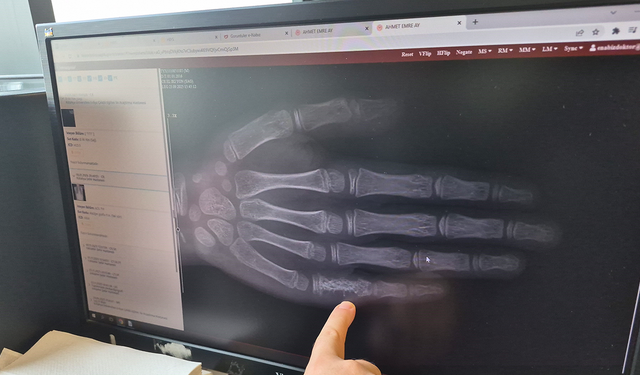 Eski̇şehi̇r'de Kanser Alarmı! Her Ay 5-7 Çocuğa Tanı Konuluyor