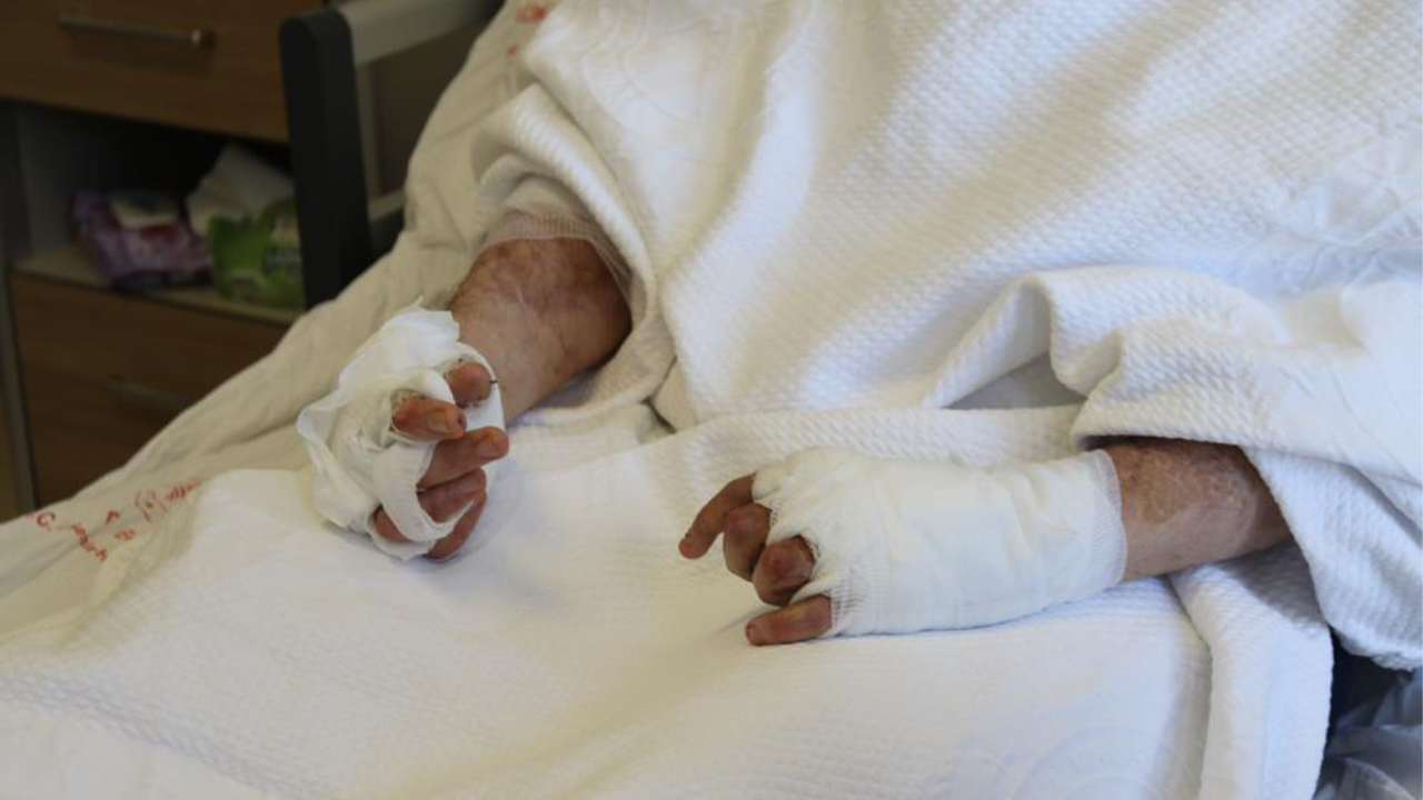 Vücudunun Farklı Noktalarında Yanıklar Oluştu