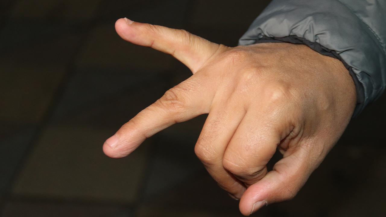 Darp Sonrası Parmağında Kırık Meydana Geldi