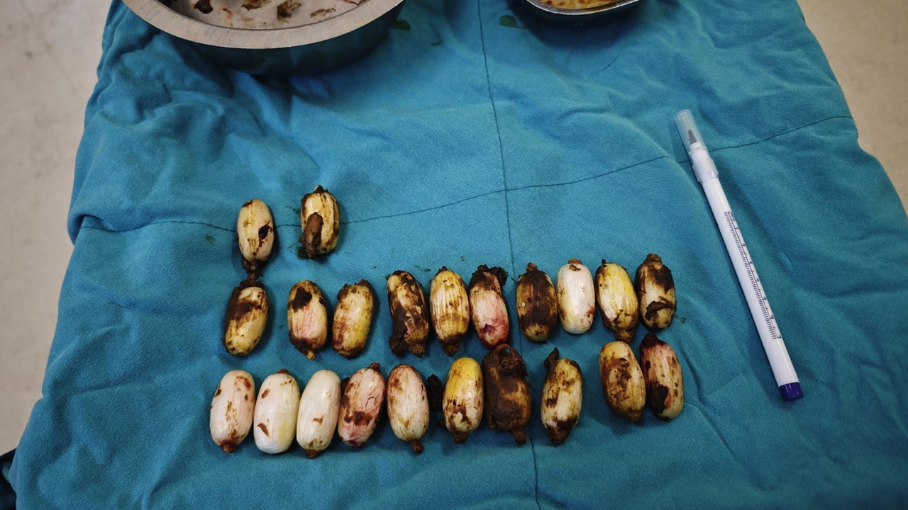 Cerrahi Işlemle Çıkarıldı