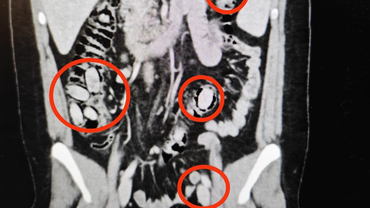 Kapsüller Bu Şekilde Tespit Edildi