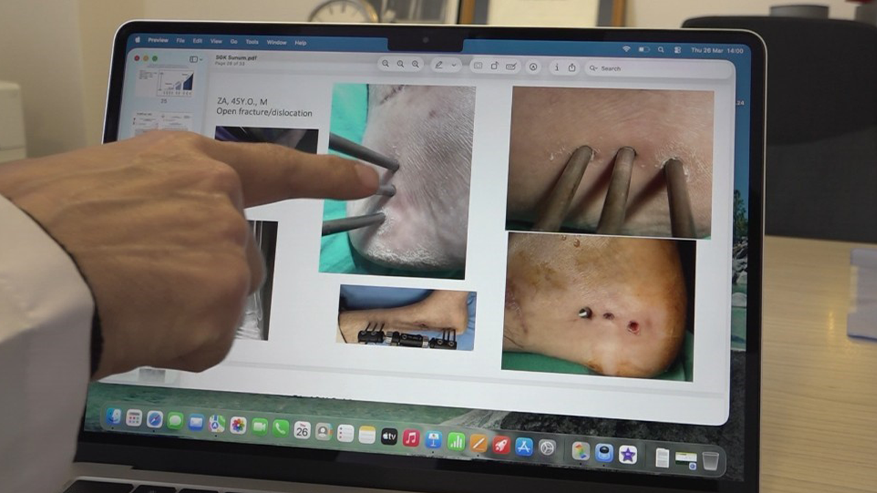 78 Hastada Uygulandı